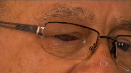 Mutirão de cirurgia de catarata deixa mais de 20 contaminados por bactéria; Idosos perderam a visão